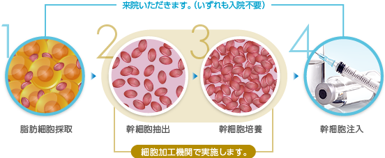 1.脂肪細胞採取（来院いただきます。（いずれも入院不要）） / 2.幹細胞抽出（細胞培養機関で実施します。） / 3.幹細胞培養（細胞培養機関で実施します。） / 4.幹細胞注入（来院いただきます。（いずれも入院不要））