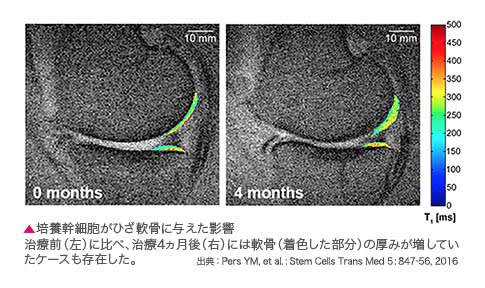 培養幹細胞がひざ軟骨に与えた影響 治療前（左）に比べ、治療4ヵ月後（右）には軟骨（着色した部分）の厚みが増していたケースも存在した。 / 出典：Pers YM, et al. : Stem Cells Trans Med 5: 847-56, 2016