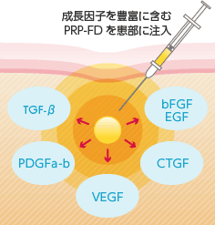 成長因子を豊富に含むPRP-FDを患部に注入